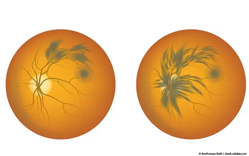 Retinaler Venenverschluss