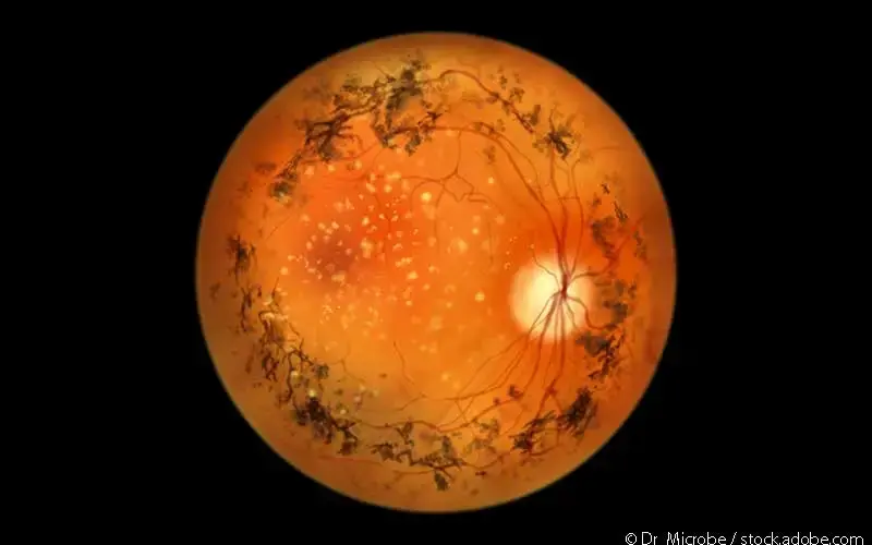 Retinitis pigmentosa