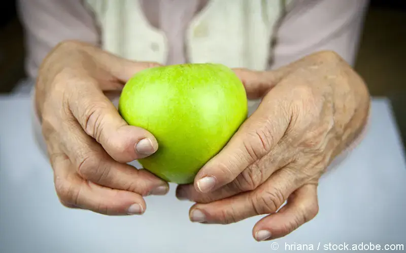 Rheumatoide Arthritis Hand