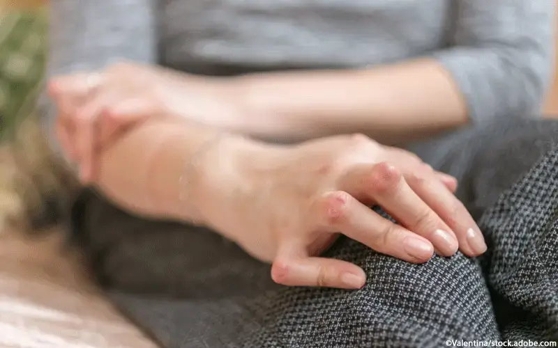 Rheumatoide Arthritis Patientin