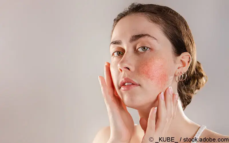 Rosacea