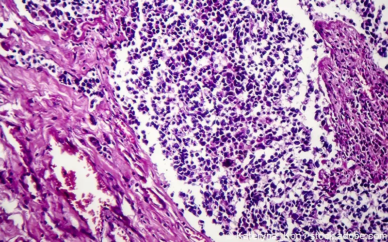 SCLC Small-Cell-Lung-Cancer