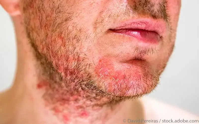 seborrhoische Dermatitis