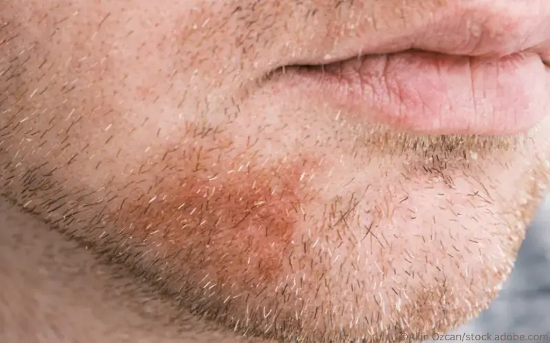 Seborrhoisches Ekzem