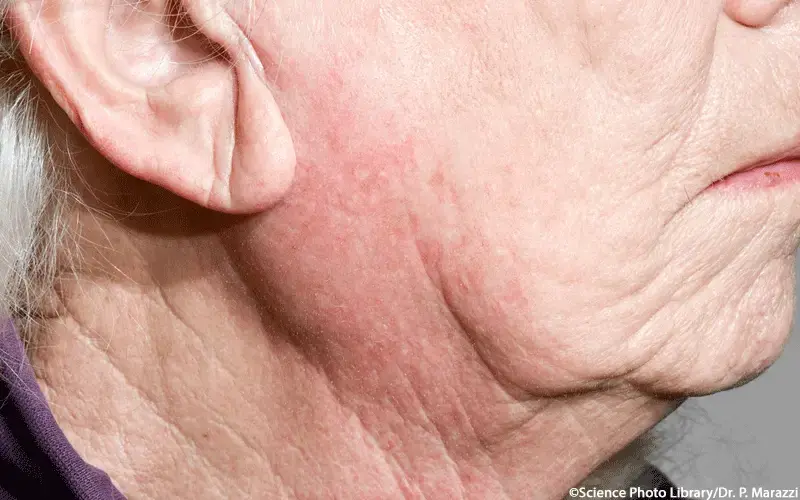 Speicheldrüsentumor