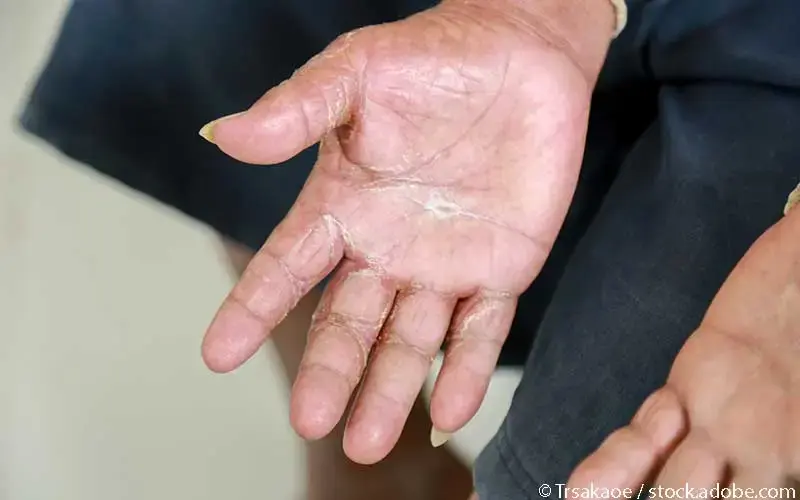 Systemische Sklerose Hände