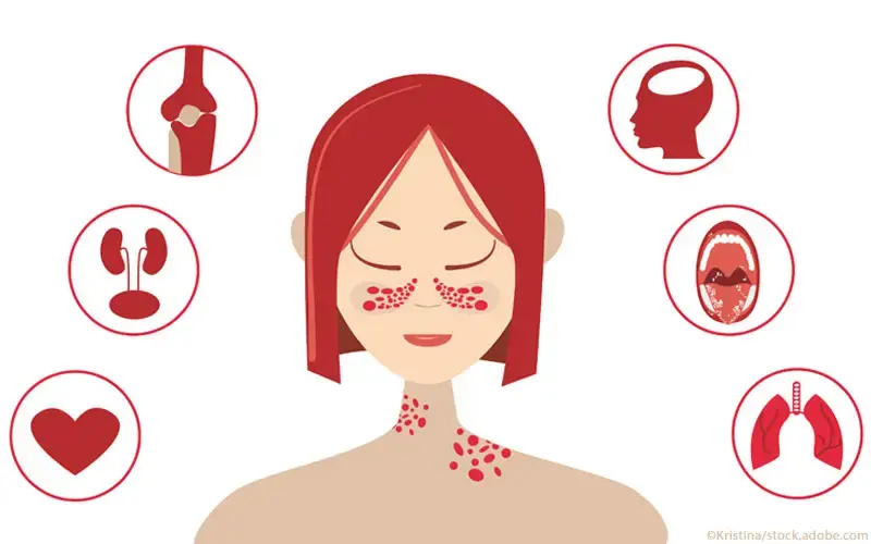 Systemischer Lupus erythematodes