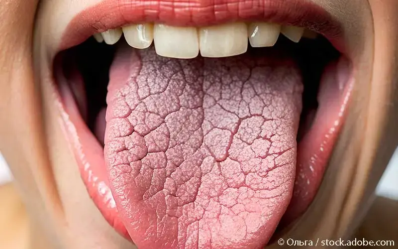 trockene-zunge