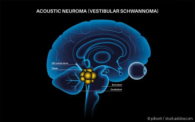 Vestibularisschwannom