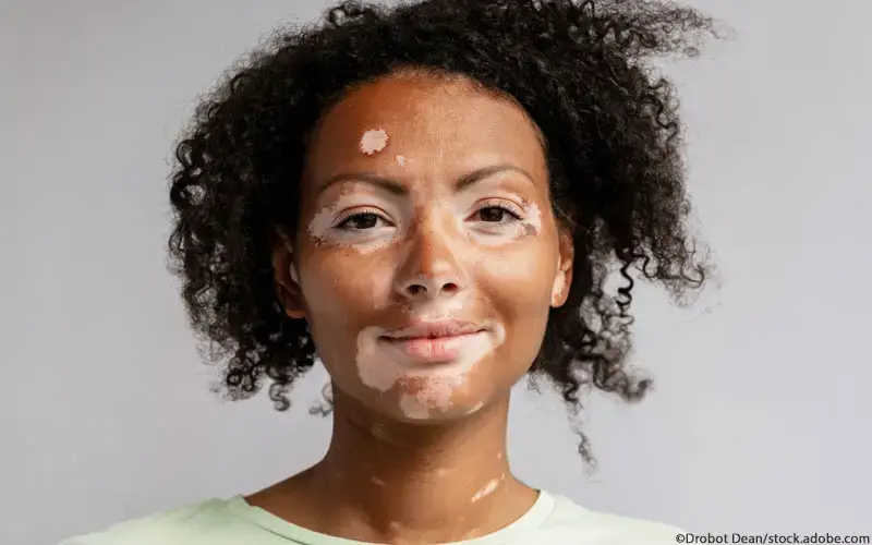 Vitiligo Frau