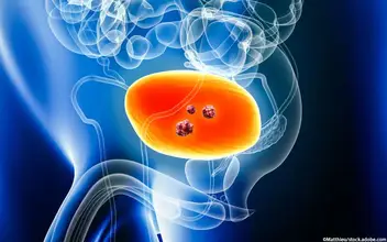 Blasenkrebs Urothelkarzinom Blasenkrebs Urothelkarzinom