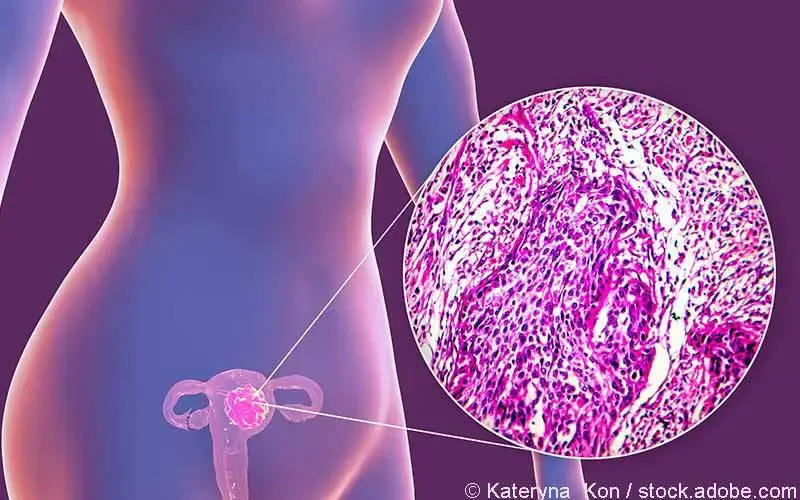 Endometrium-Karzinom Endometrium-Karzinom