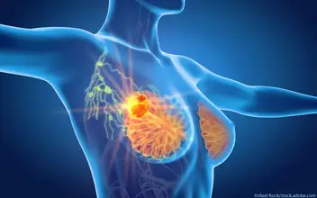 Mammakarzinom Mammakarzinom