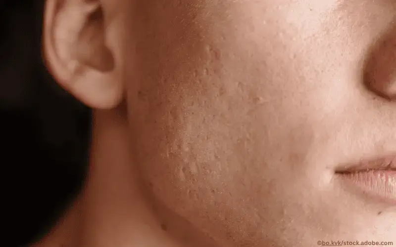 Akne-Narben-Haut-Gesicht-Mann