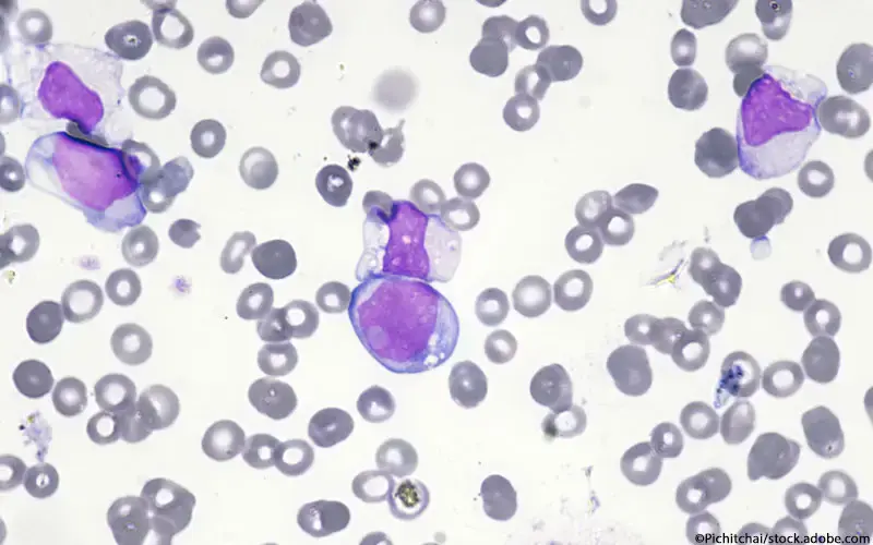 Akute Myeloische Leukämie