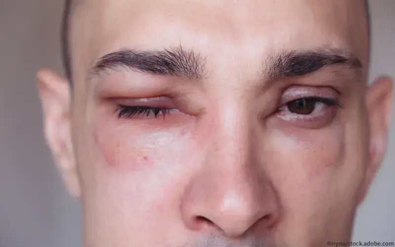 Angioödem Auge