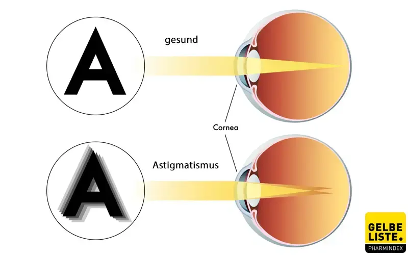 Astigmatismus Symptome, Diagnostik, Therapie Gelbe Liste