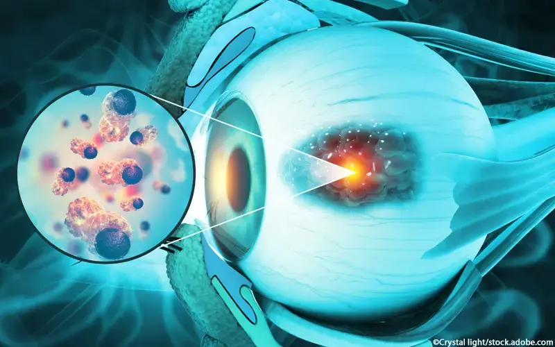 Augenkrebs_Retinoblastom