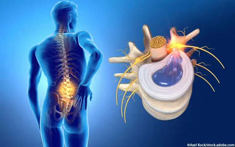 Bandscheibenvorfall