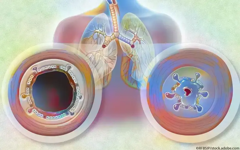 Welche Blutwerte sind bei einer Bronchitis erhöht?