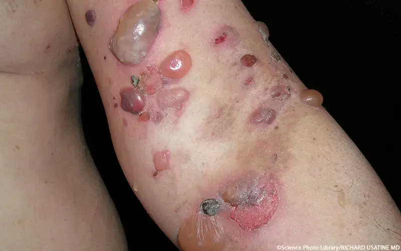 Bullöses Pemphigoid