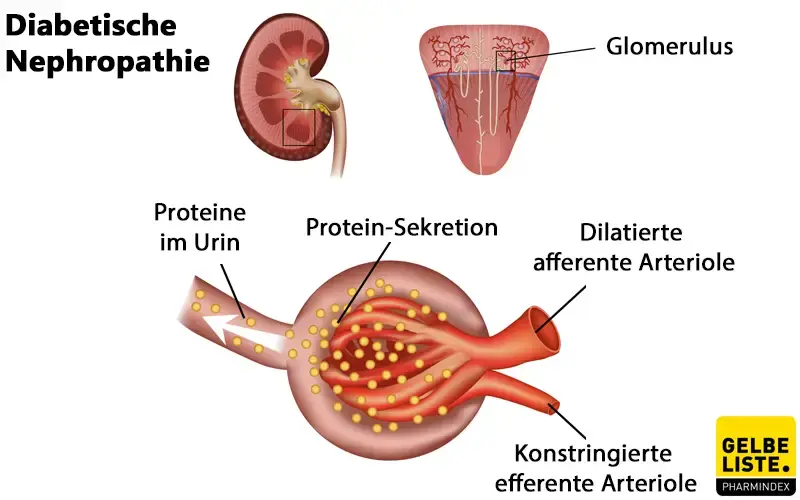 Diabetische Nephropathie