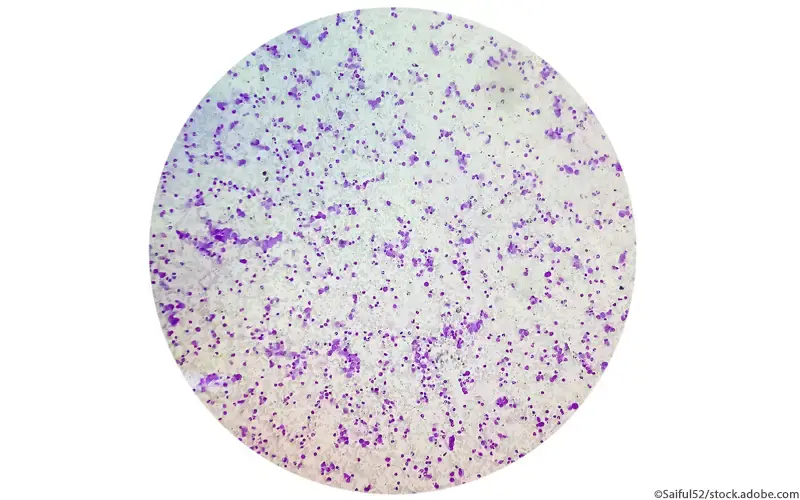 Essentielle Thrombozythämie 