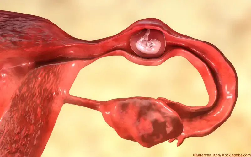 Extrauteringravidität