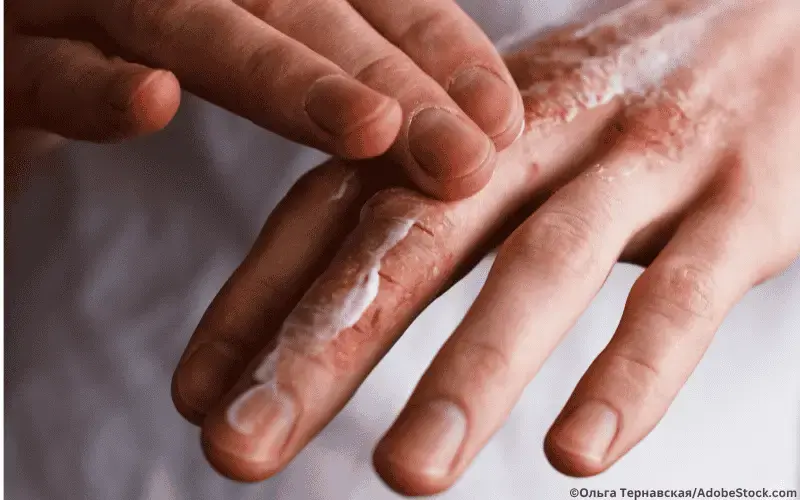 Hand-Ekzem-Creme-Allergie-Dermatitis