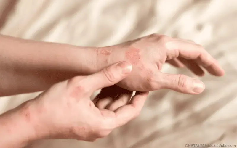 Hand-Ekzem-Frau-Entzündung-Ausschlag