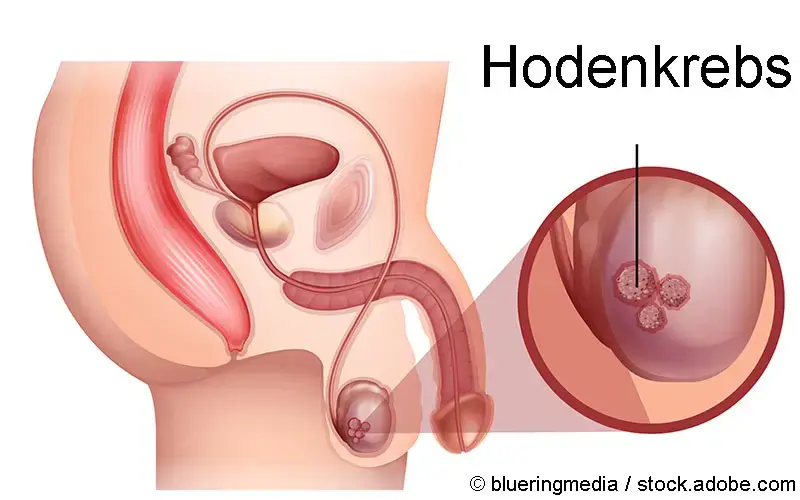 Hodenkrebs Skizze