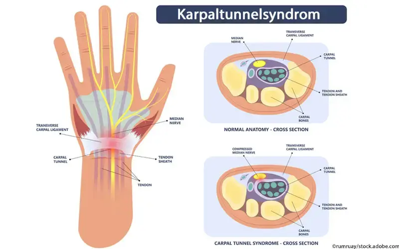 Karpaltunnelsyndrom