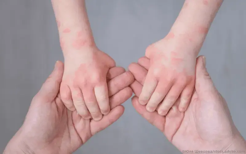 Kinderhände-Dermatitis-Eltern-Hand