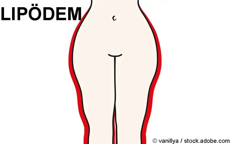 Lipödem