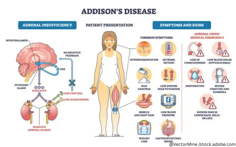 Morbus Addison