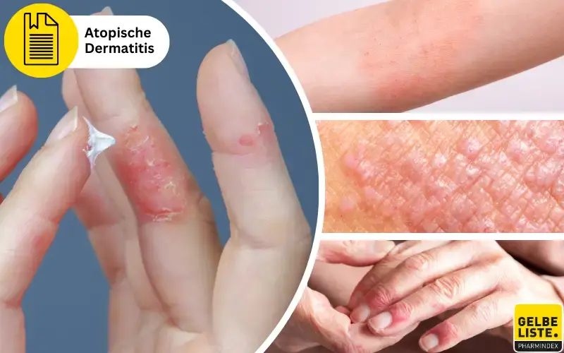 Neurodermitis Slider