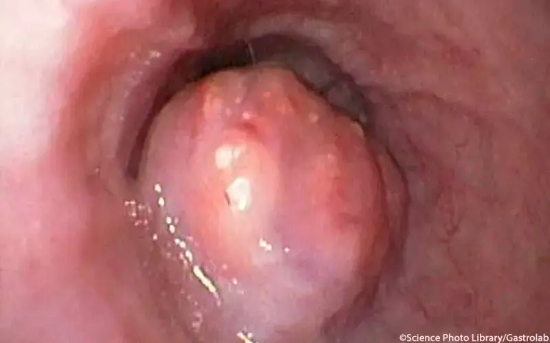 Ösophaguskarzinom Endoskopie