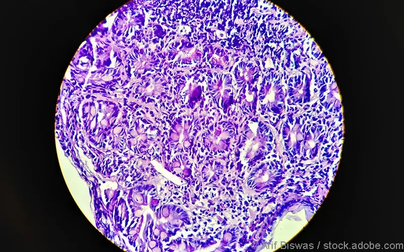 Plattenepithelkarzinom