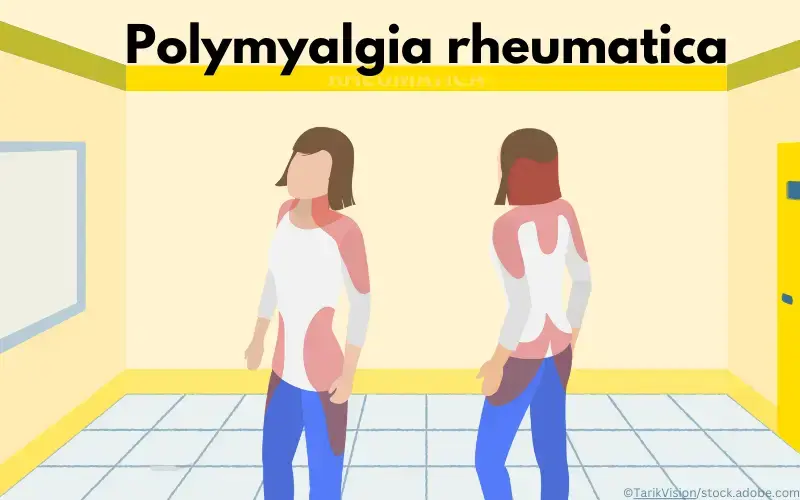 Polymyalgia rheumatica