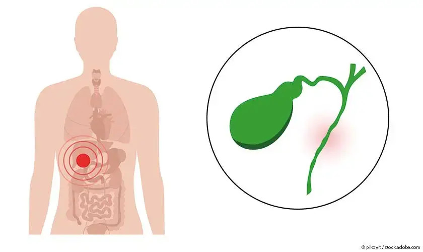 Primaere sklerosidierende Cholangitis