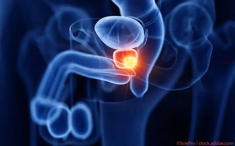 Prostatakarzinom