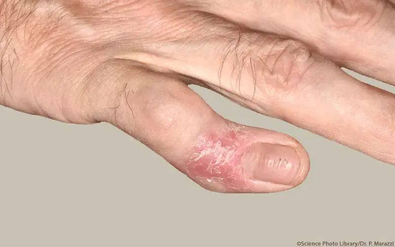 Psoriasis-Arthritis