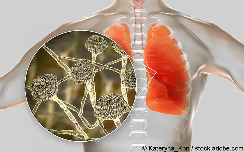 Pulmonale Aspergillose