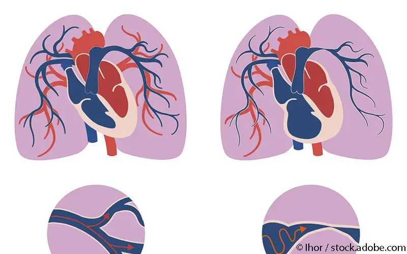 Pulmonale Hypertonie-Schema
