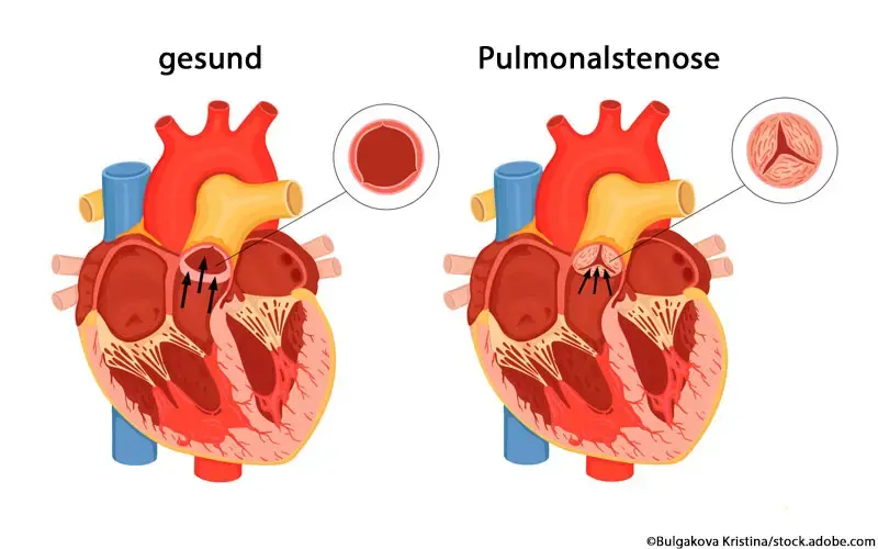 Pulmonalstenose