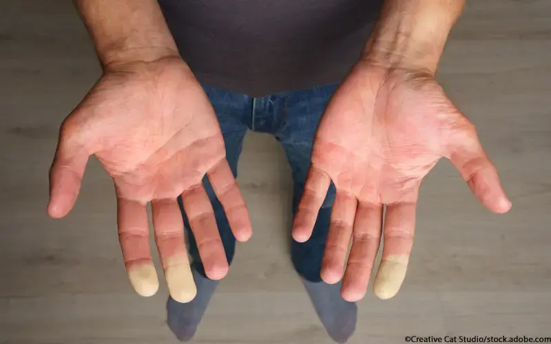 Raynaud-Syndrom