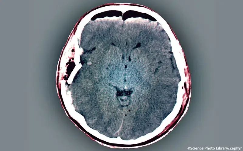 Schädel-Hirn-Trauma