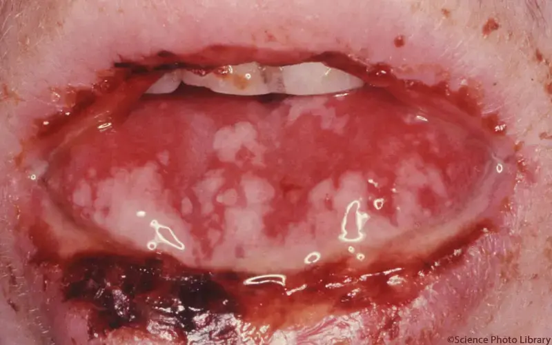 Stevens-Johnson Syndrom