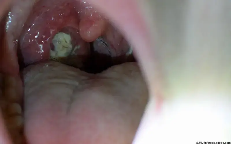 Tonsillitis