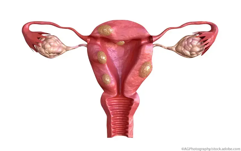 Uterusmyom